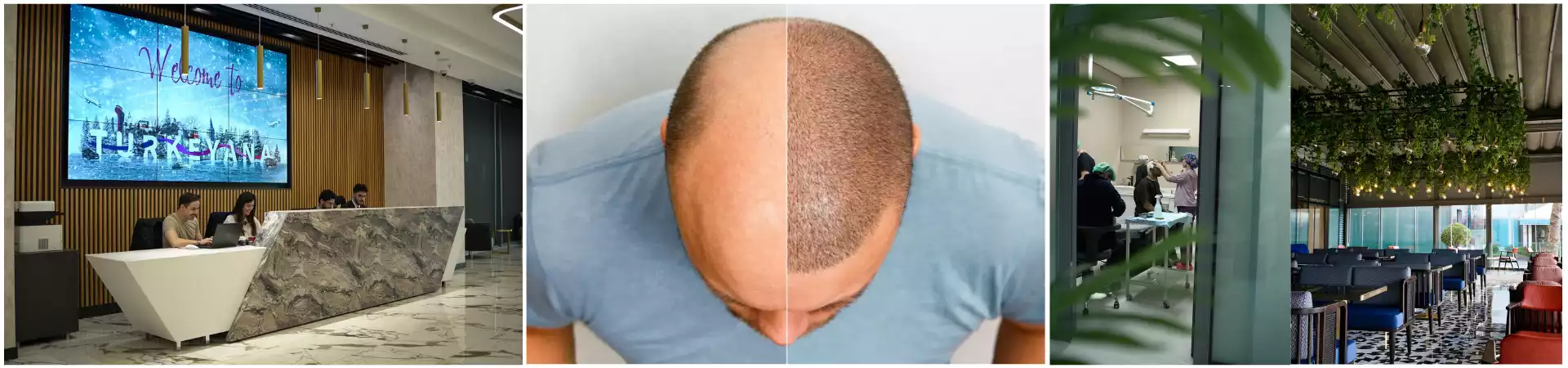 Hair Transplant 20% Off with E-pass