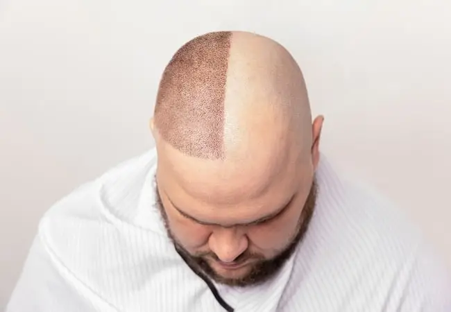 Hair Transplant 20 Off With E Pass